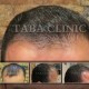 کاشت موی طبیعی تاباکلینیک