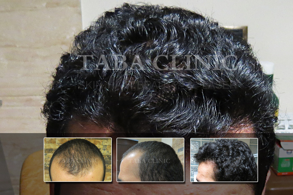 کاشت موی طبیعی تاباکلینیک